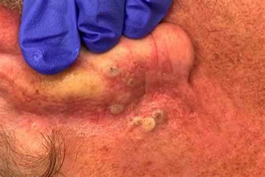 Blackheads Comedones Extraction Behind the Ear