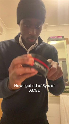 How I Overcame 5 Years of Acne