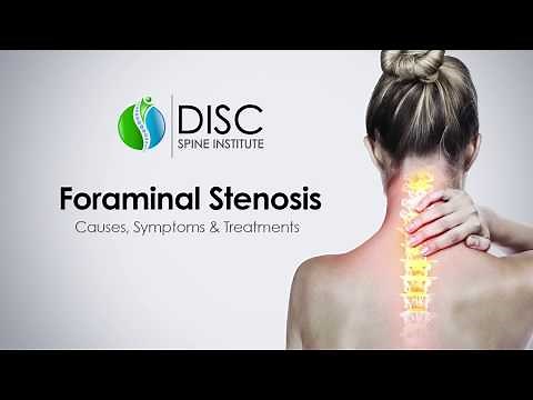 Pinched Nerve in Neck or Back, Foraminal Stenosis: Causes, Symptoms, Treatments
