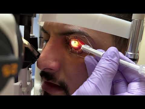 Removal of Metal Embedded in Cornea