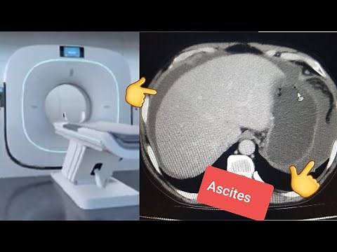 abdominal ascites examination