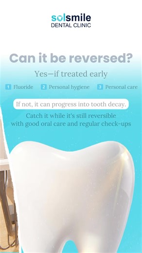 Chalky white spots on your teeth? 👀 They might look harmless, but they’re actually an early warning sign of demineralization, meaning your enamel is starting to weaken. This happens when acids from food, drinks, or poor oral hygiene begin to strip minerals from your teeth. The good news? Catching it early means you can still protect and restore your enamel before it leads to cavities or sensitivity. If you’re noticing these spots, it’s best to get your teeth checked so we can guide you with the