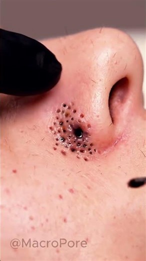 Nose Comedone Cluster Extraction | 4K Macro ASMR