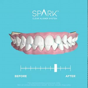 A frequent question we are asked is, how do the aligners work? Our licensed providers prescribe them on a case-by-case basis, depending on your treatment plan. Typically, you can expect to get a new set every one to two weeks based on your clinician's preference. Regular check-ins with your doctor will ensure you’re on the right track. You may experience slight pressure and discomfort with each new aligner transition. This experience is completely normal, but check in with your provider at any t