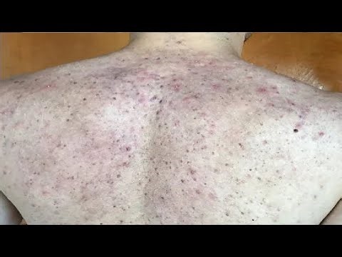 REMOVE CHEST AND BACK ACNE SCARS PERMANENTLY