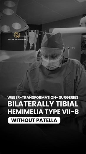 Prof.Dr.Michael Weber on Instagram‎: "Weber-Transformation- Surgeries preventing amputations in 3 year old boy with bilaterally Tibial Hemimelia type VII-b without patella. تحويل ويبر – جراحات منقذة للأطراف منعت بتر الساقين لطفل يبلغ من العمر 3 سنوات يعاني من Tibial Hemimelia ثنائية من النوع VII-b بدون رضفة. Book your consultation today. +971 52 950 0902 #WeberTransformation #LimbSalvageSurgery #TibialHemimelia #OrthoInnovation #PediatricCare #MiracleMedicine #NoAmputation #HopeRestored #GlobalO