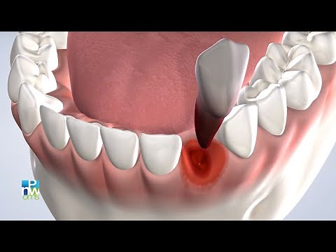 Post-Operative Instructions: Multiple Extractions | Pacific Northwest Oral & Maxillofacial Surgeons