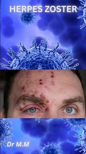 Herpes Zoster: Painful Rash You Should Never Miss