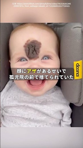 【色素細胞性母斑】#shorts #雑学 #医学 #サイエンス #ほくろ #ガン #皮膚 #医学 #science
