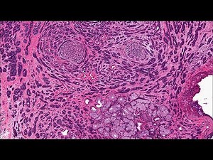 Salivary gland Polymorphous adenocarcinoma and differential