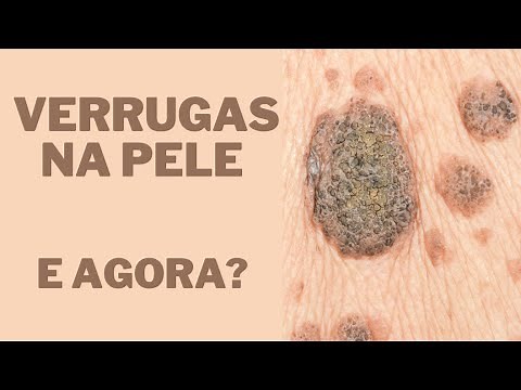 Verrugas - Quais os tipos e como tratar? Por Luiz Gameiro, dermatologista