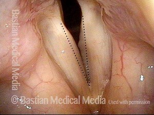 Inspiratory Phonation: Noisy Breathing (Photos   Video)