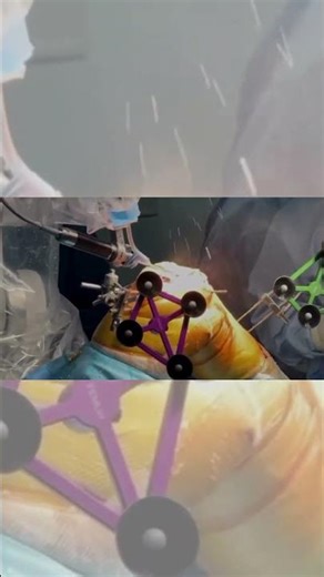 Why Robotic Knee Replacement Is a Game-Changer | Faster Recovery & Precision Surgery