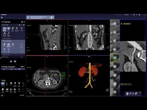 syngo.via CT Vascular