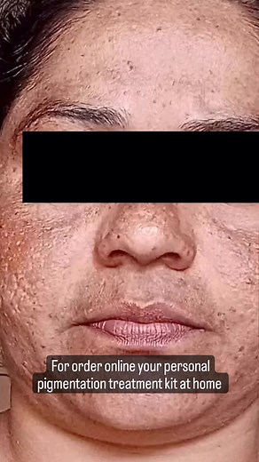 1.2K views · 14 reactions | Call us.9813903484 for order online your personal pigmentation treatment kit at home #reelsfb #facebookreels #trend #tbt #facetreatment #trending #skincare #hair | Nisha Lambha - Sparsh Beauty Care & Hair Treatment LLP 5 | Facebook