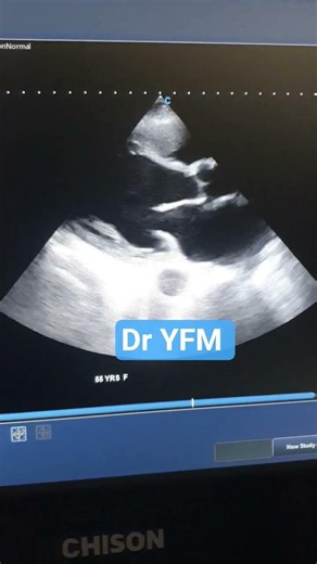 DCMP ( global LV hypokinesis, moderate to severe LV systolic dysfunction)