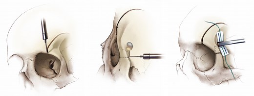 Orbitozygomatic Craniotomy | Cohen Collection | Volumes | The Neurosurgical Atlas