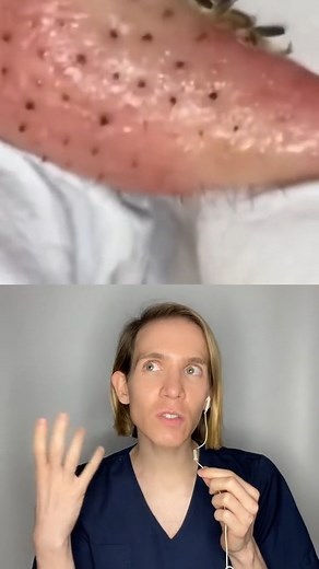 406K views · 6.1K reactions | ¿Sufren de filamentos sebáceos? | Simon Scarano Dermatólogo | Facebook