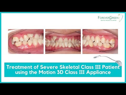 Forever Green | Treatment of Severe Skeletal Class III Patient with Motion 3D™ Class III Appliance