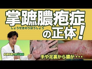 掌蹠膿疱症の正体！手の平や足の裏から膿が・・・