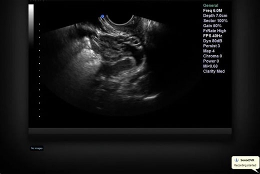 Transvaginal Uterus long