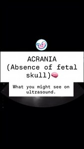 🫶🏼 ACRANIA - absence of fetal skull, causing brain tissue to be exposed to amniotic fluid inside the womb. Wat you might see on ultrasound: • exposed brain tissue 🧠 • normal eye opening 👀 • normal movements 👍🏼 • normal facial features 👶🏻 • normal heart rate 💓 • normal sucking 😋 • plus, a normal NIPT 🧬 | Peek-A-Boo Baby RGV