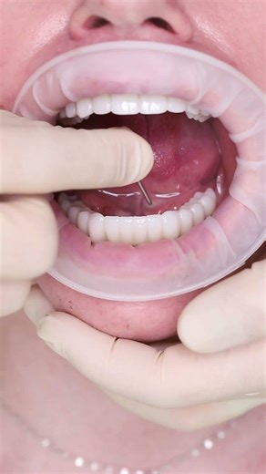 Dental implant’s All on X in Prague #shorts #dentist #dental #implant #veneers #short