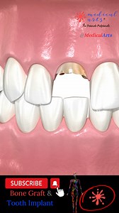 866K views · 1.3K reactions | Bone Block Grafting: A Key Technique...