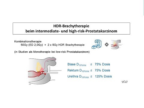 HDR brachytherapy for prostate cancer | Radiation therapy Prof. Hilke Vorwerk