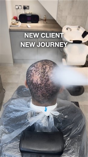 AKN Treatment #ingrownhair #akn #bumptreatment #barber