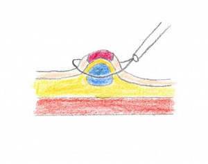 これでわかる 新人看護師必見！ 内視鏡看護 介助No.26 内視鏡的粘膜切除術 EMR① 治療の流れと看護 適応・禁忌・偶発症 | milky blog