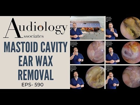 MASTOID CAVITY EAR WAX REMOVAL - EP590