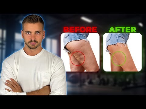 The ONLY Way to Get Rid of Cellulite (2025)