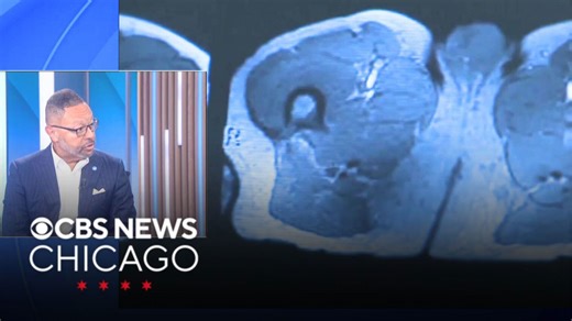 Cook Co. Commissioner shares cancer survival story, encouraging men to get tested