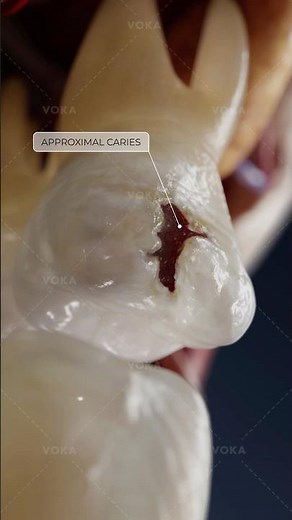 What are Class II dental caries and why should they be treated promptly? Dentistry in 3D