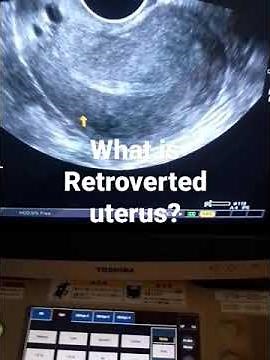 what is Retroverted uterus??and how looks on tvs ultrasound
