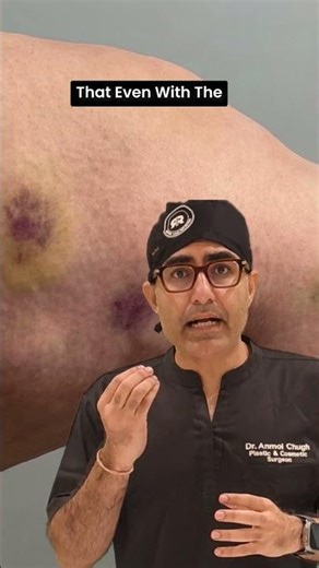 Lipedema Pain Is Not “Normal” Pain - Know the Signs