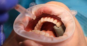 Dentist applies dental sealant to patient teeth using UV light. Medic in gloves works in open mouth making treatment procedure in dentistry