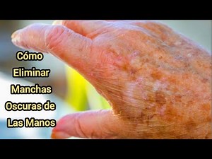 How to Remove Dark Spots from Your Hands. Quick and Easy
