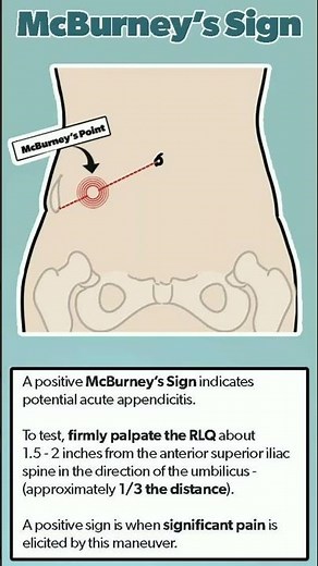 McBurney's Sign In appendix #doctor #shortsfeed #short #shortsvideo