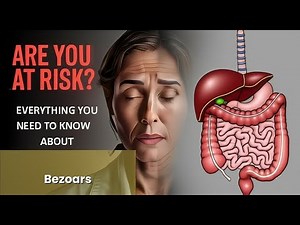 Bezoars Explained Causes, Symptoms and Treatment, All Insights