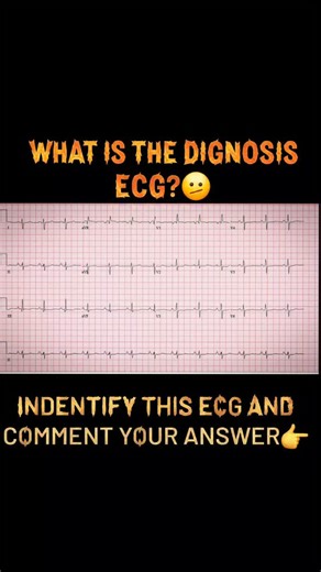 Ecg Territories on Instagram: "Dignosis the ecg?🙂‍↕️ . . . . . ecgclassroom #ecgtechnician #ecgplus1 #doctor #cardiologydepartment"