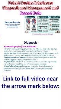 Patent Ductus Arteriosus: Diagnosis and Management and Recent Data
