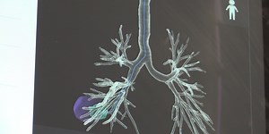 Technology helps with earlier detection of lung cancer