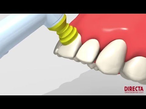 ProphyCare® Prophy Cup by Directa - Optimal cleaning, superior paste holding