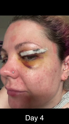 Blepharoplasty recovery day 1 to 6! #blepharoplasty #surgery #eyelidsurgery #hoodedeyes #bleph #blepharoplastysurgery #blethraplasty