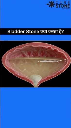 How does bladder stone blocks the urethra | How bladder stone causes obstruction