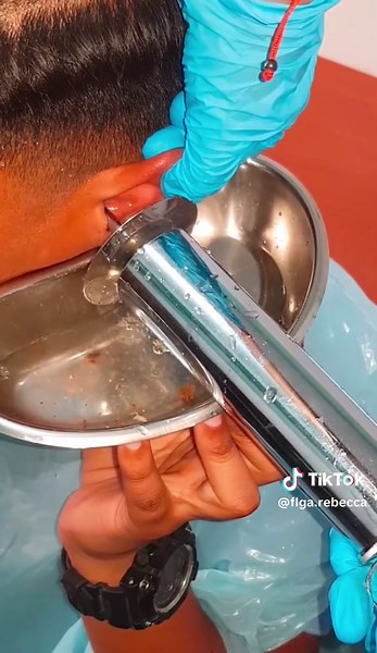 Atenciones disponibles en chile 🇨🇱👂 #verano #piscina #enero #tapondecerumen #cerilla #oidos #fonoaudiologia #otoscopy #chile #parati #viral #2024 #fyp #lamoneda #santiago #asmr #npc #trending #salud