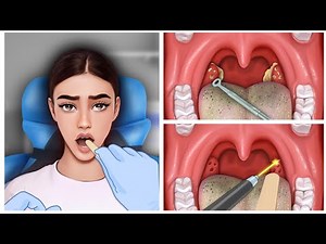 ASMR satisfying tonsillitis & tonsil stone removal animation / asmr扁桃石アニメーション
