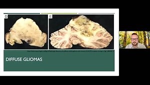 Diffuse Glioma: A Serious and Under-Recognized Mimic of Inflammatory CNS Disease